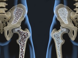 osteoporosis-2